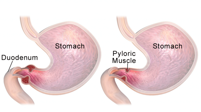 Pyloric Stenosis Clinical Features Management Teachmepaediatrics