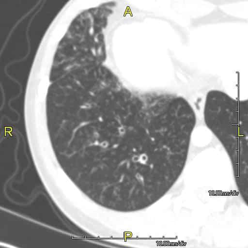 HRCT in a patient with cystic bronchiectasis showing dilatation of the... |  Download Scientific Diagram