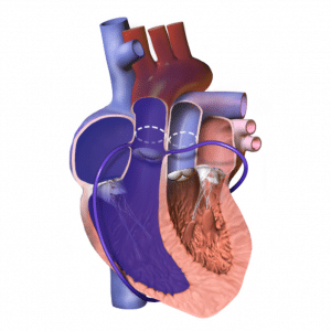 Congenital Heart Defects - TeachMePaediatrics