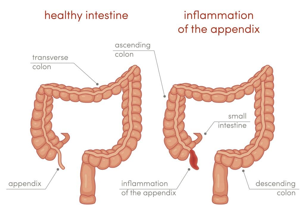 what causes anorexia in appendicitis