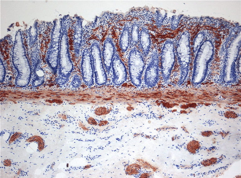 Hirschsprung's Disease - Pathophysiology - TeachMePaediatrics