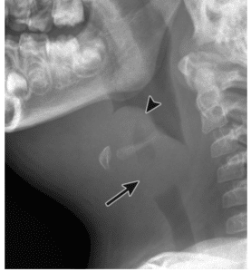 Epiglottitis - TeachMePaediatrics