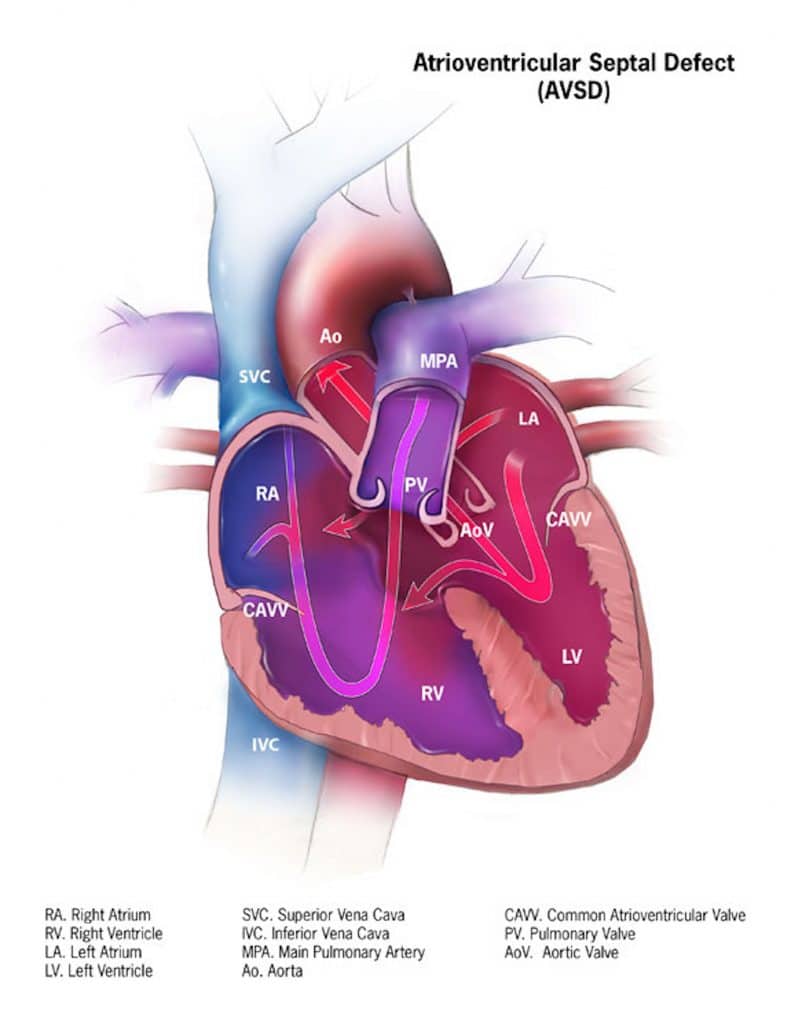 Congenital Heart Defects - TeachMePaediatrics