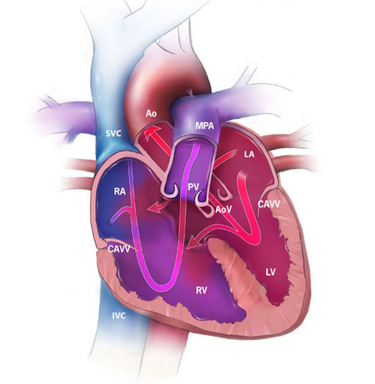 Structural Heart Defects - TeachMePaediatrics
