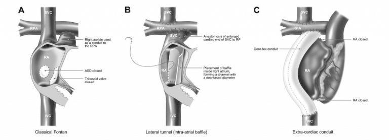 Tricuspid Atresia - Pathophysiology - Management - Teachmepaeds