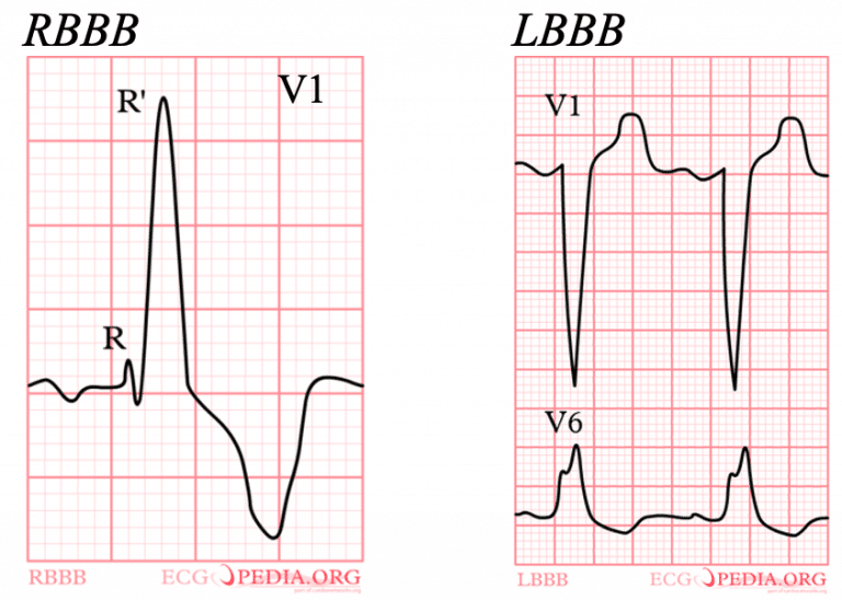 ECG interpretation - Rate - Rhythm - Cardiac Axis - TeachMePaeds