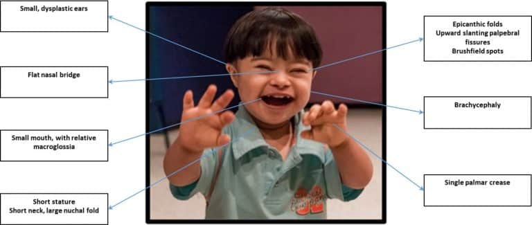 Down Syndrome TeachMePaediatrics   Image Down Syndrome Features 768x325 