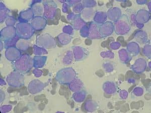 Image showing a stained bone marrow sample with myeloblasts in AML