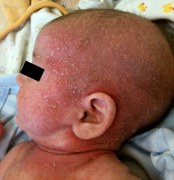 Infant with dermatitis on face and scalp