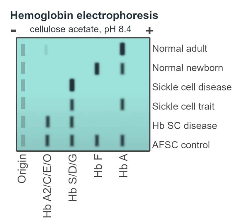 Sickle Cell Disease - Management - Complications - TeachMePaediatrics