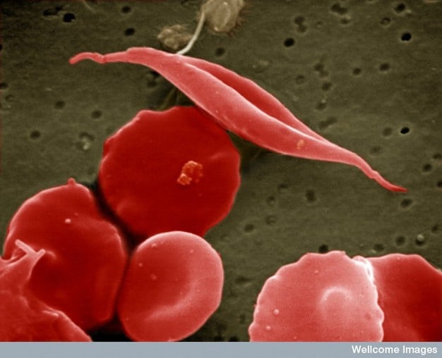 EM image of sickled red cell