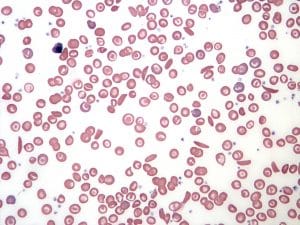 Blood film in sickle cell anaemia