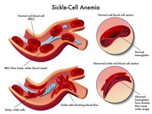 Graphic demonstrating vast-occlusive crises in sickle cell disease