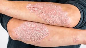 Chronic plaque psoriasis