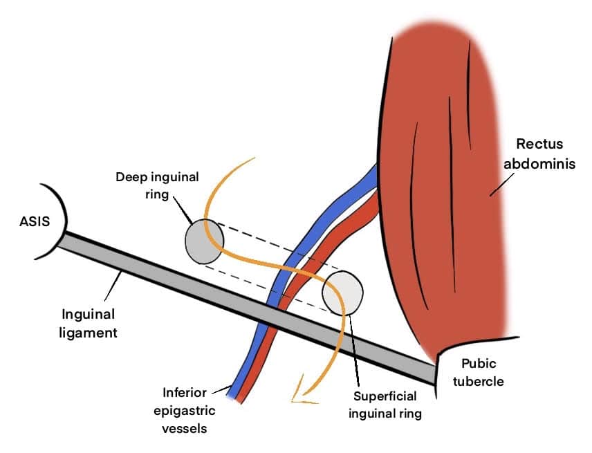Inguinal Canal - Gastrointestinal - Medbullets Step 1