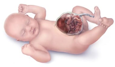 Omphalocele as component of multiple anomaly syndrome/sequence