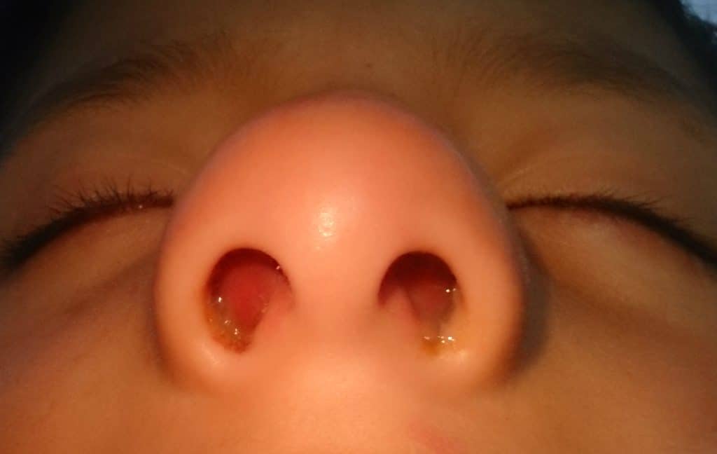 Nose TeachMePaediatrics