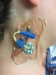 Photograph access port for venous central line located in the right IJV cited at the right side of the neck. There are no signs of infection visible