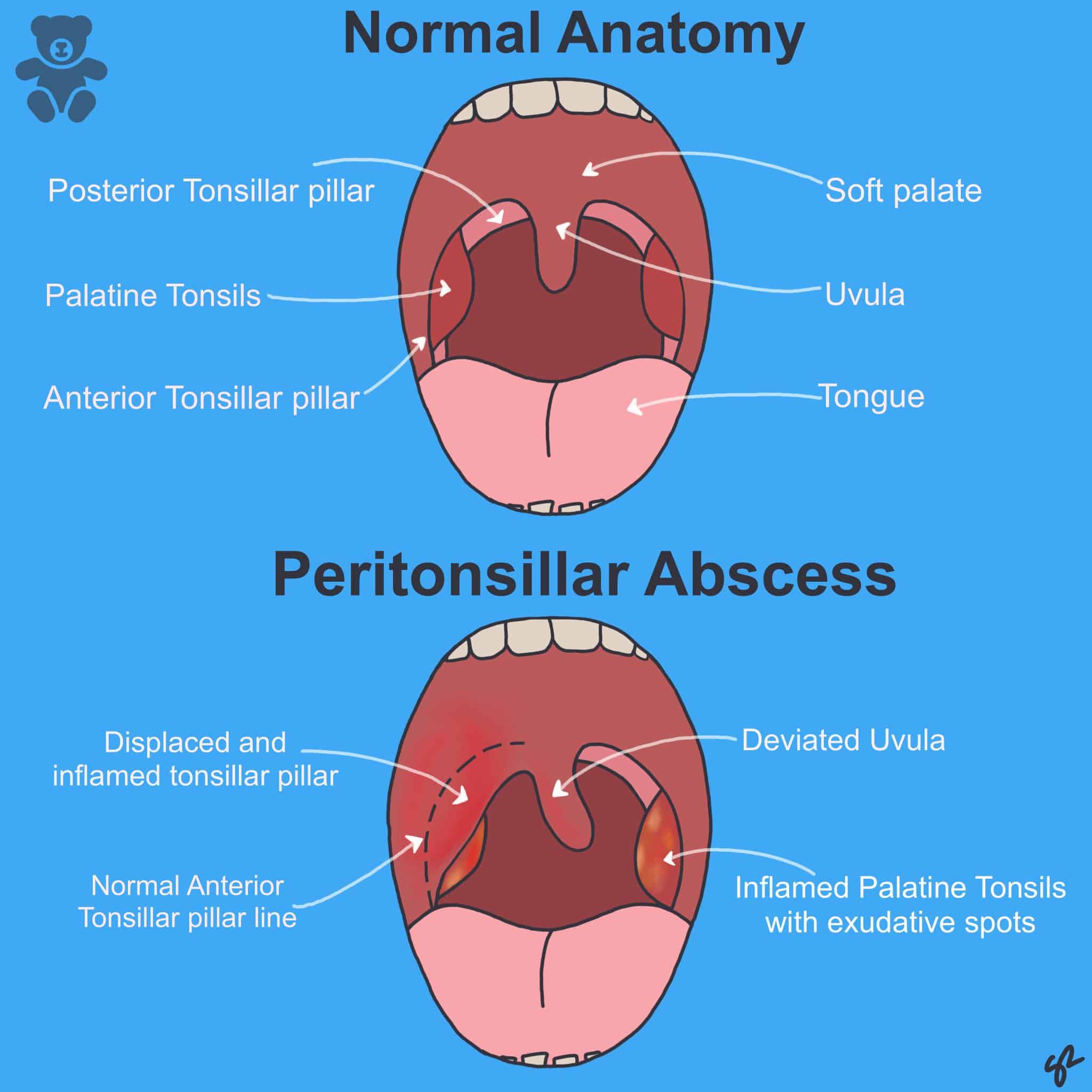 Peritonsillar abscess - Management - TeachMePaediatrics