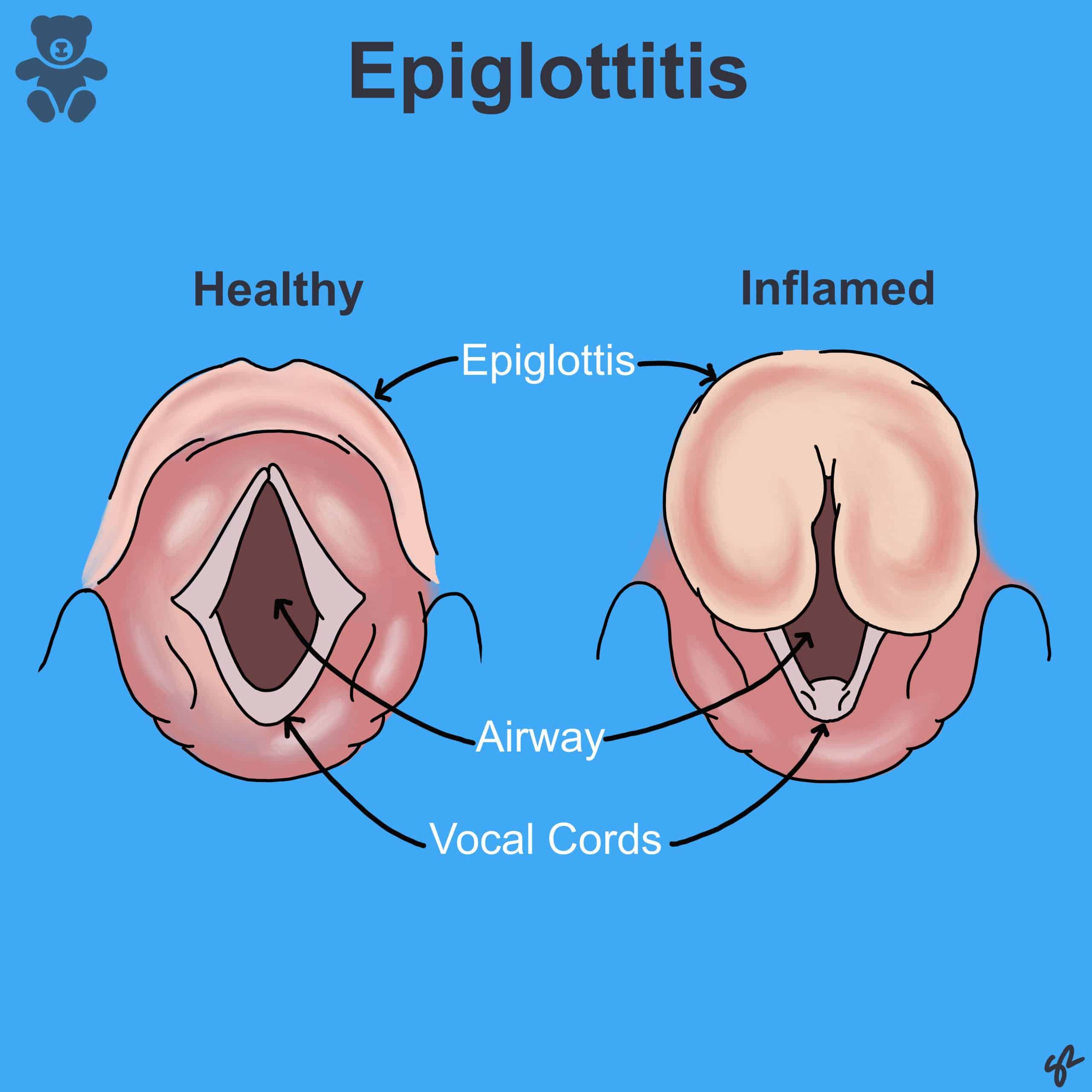 Epiglottitis Scaled 