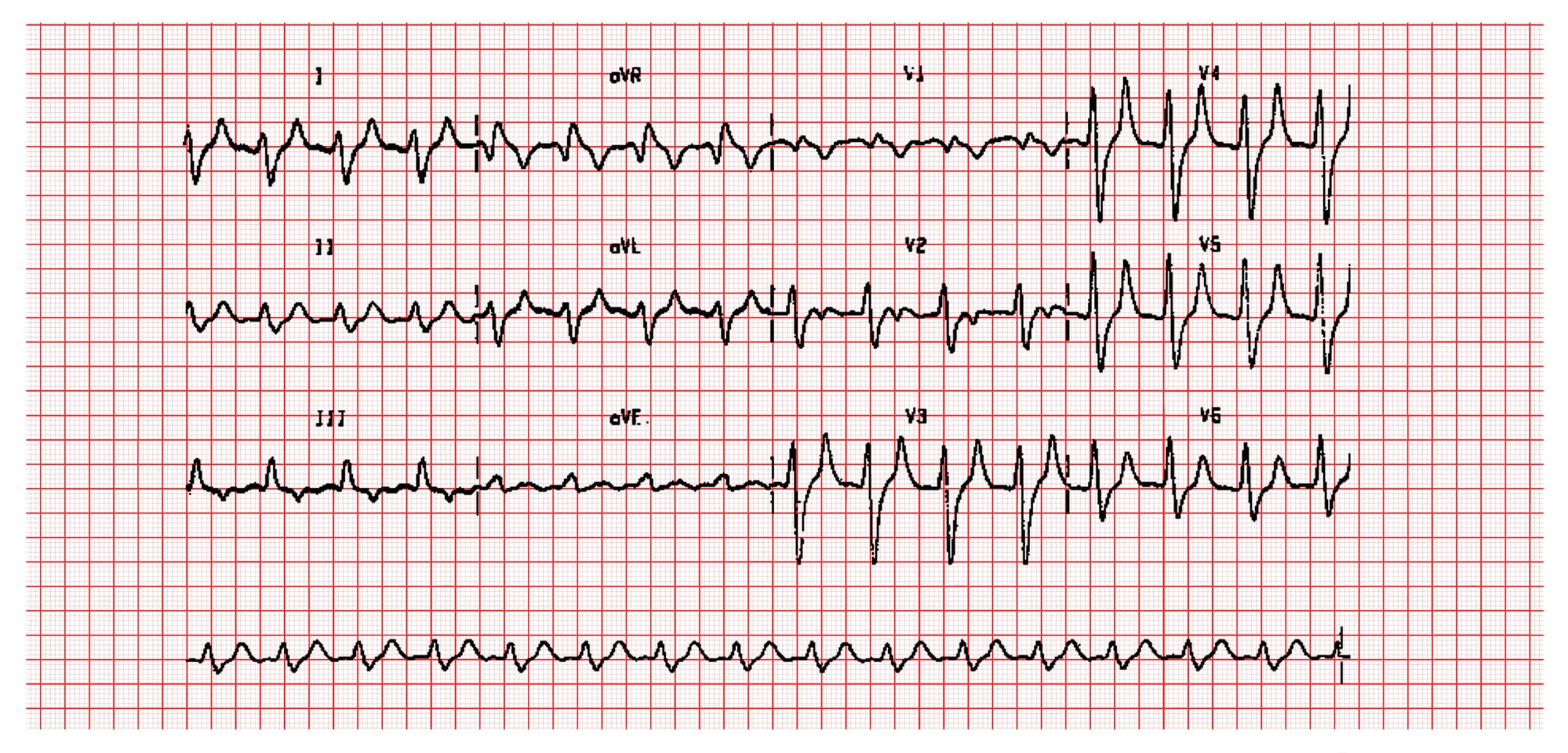 12 lead ECG showing classical changes of reduced P waves and tented T waves in hyperkalaemia
