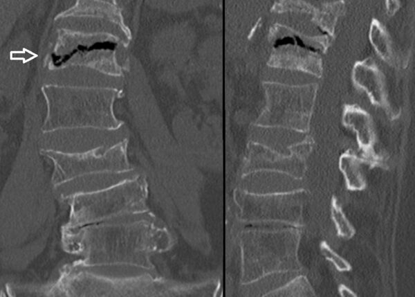 String. Sign Vertebral Oncological Emergencies - TeachMePaediatrics
