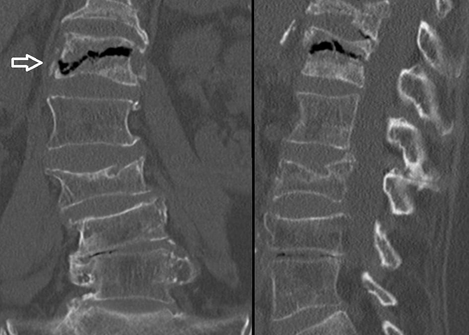 CT image showing intravertebral vacuum cleft sign, a sign of spinal cord compression