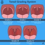 Tonsillitis - Clinical Features - Management - TeachMePaediatrics