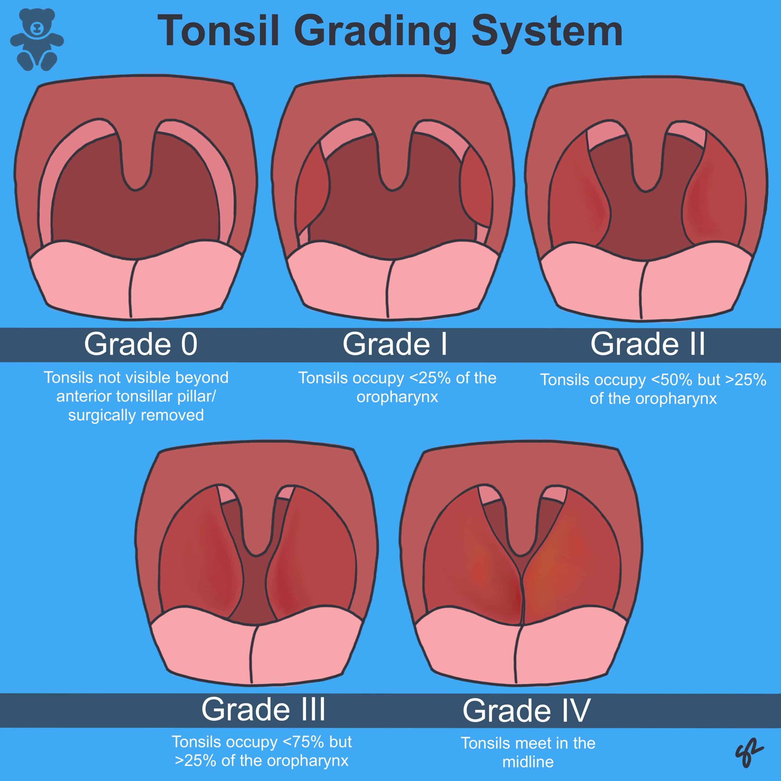 severe tonsil infection