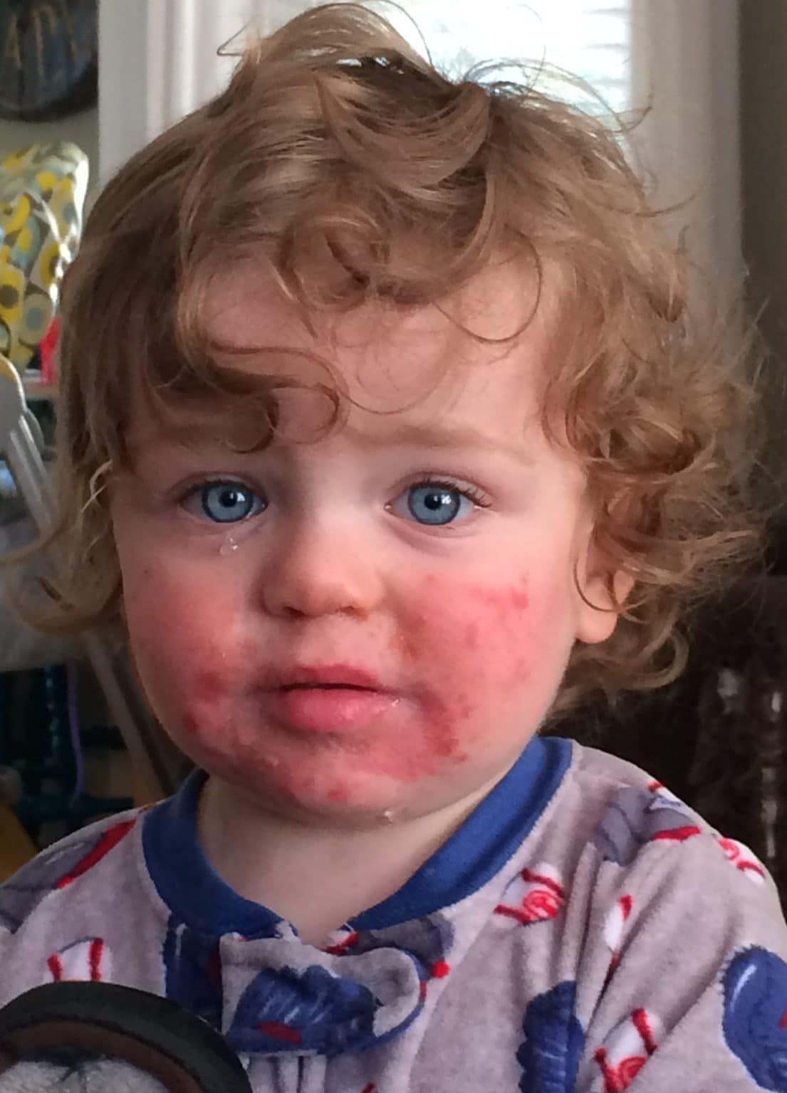 Childhood Rashes - TeachMePaediatrics