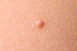 Childhood Rashes - TeachMePaediatrics