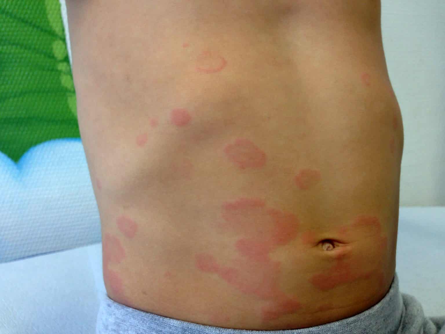Peds Rashes Childhood Rashes - TeachMePaediatrics