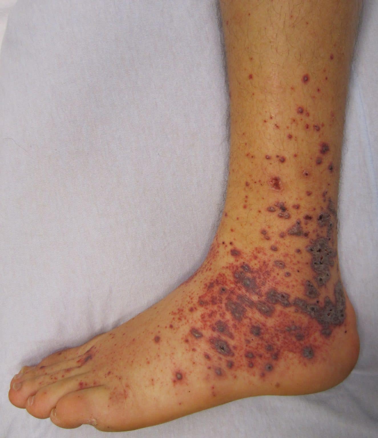 Childhood Rashes - TeachMePaediatrics
