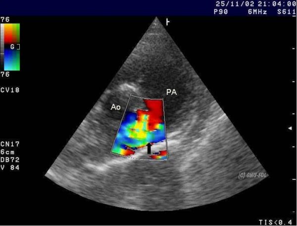 Patent Ductus Arteriosus - TeachMePaediatrics