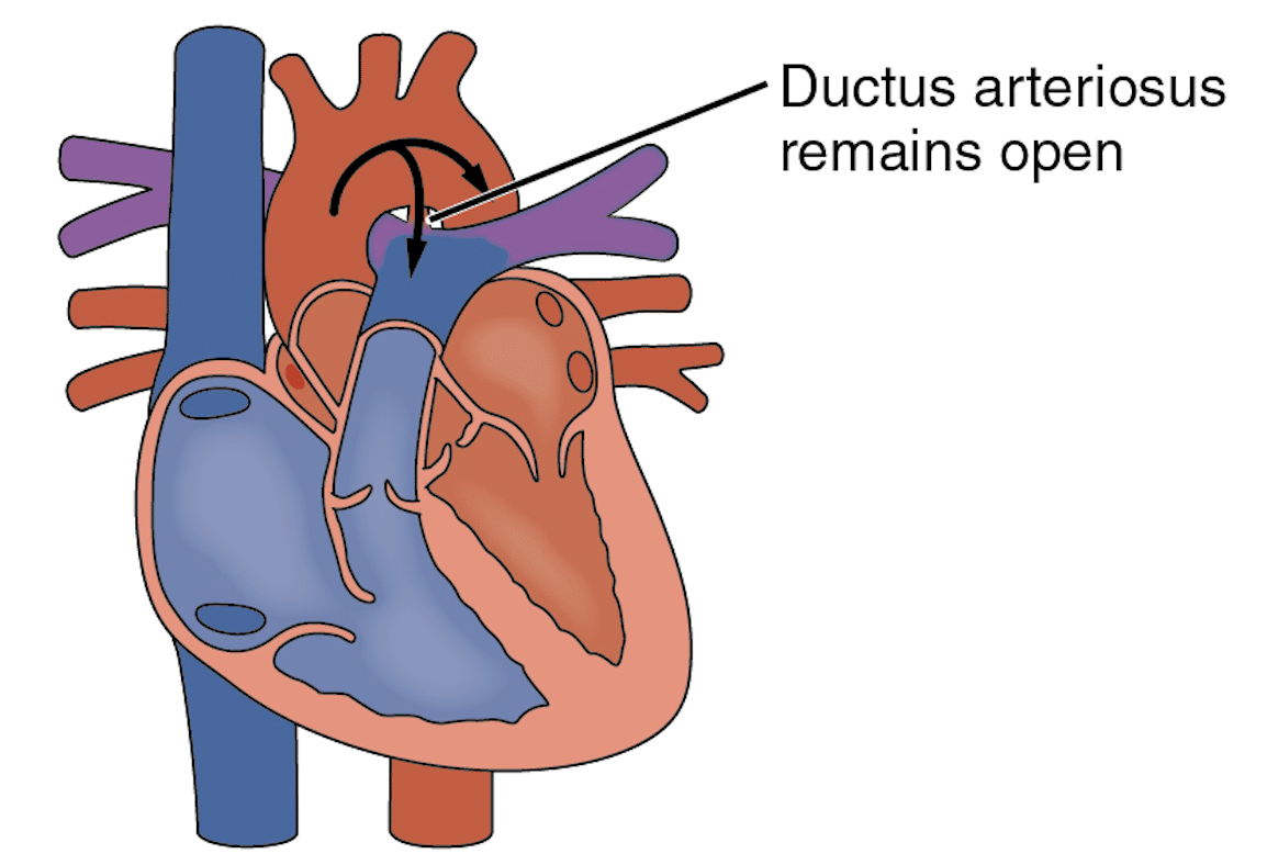 Diagram showing the reversal of blood flow from the descending aorta to the pulmonary artery through the PDA after birth.