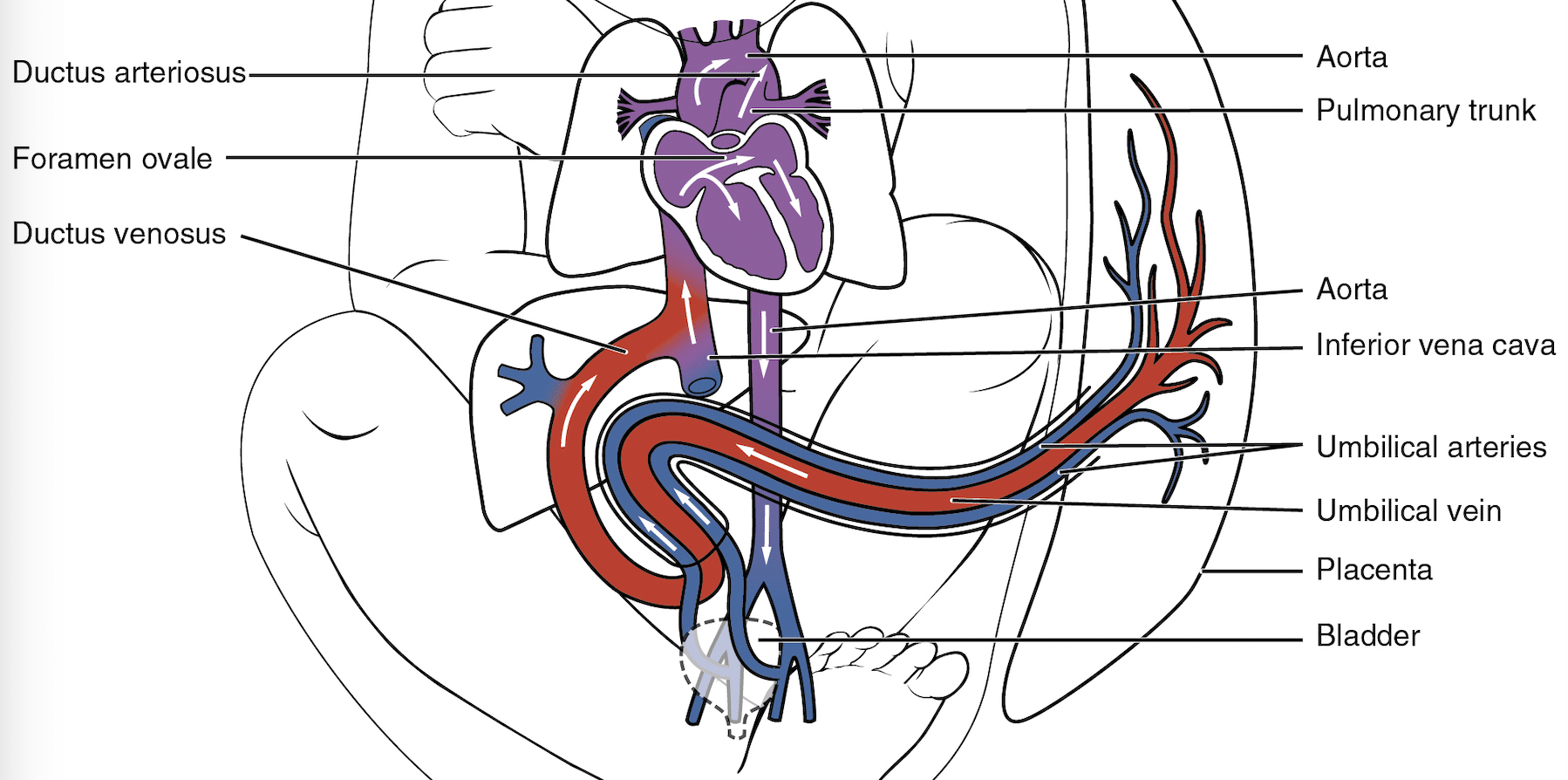 Diagram showing a child with a normal foetal circulation. Shows a direction of flow with oxygenated blood in red from the placenta through a single umbilical vein to the ductus venosus, inferior vena cava, heart, pulmonary trunk and aorta. It also shows some blood flow from the heart through the foramen ovale to the aorta. Blue deoxygenated blood is shown returning to the pairs umbilical veins to the placenta.