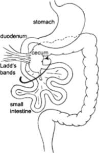 https://commons.wikimedia.org/wiki/File:Depiction_of_the_Ladd%E2%80%99s_band_caused_by_bowel_malrotation.jpg